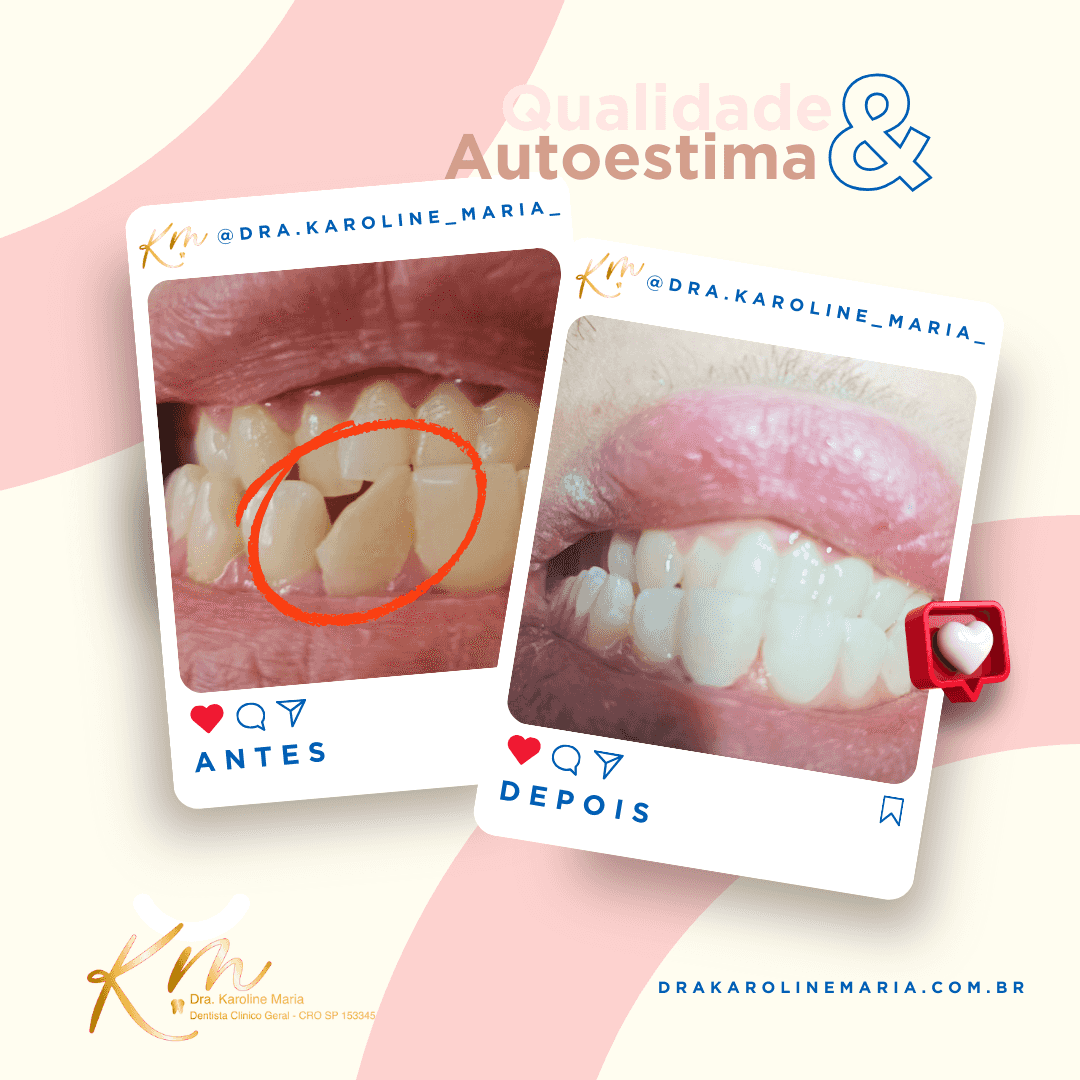 Estética em Osasco: Recuperando Sorrisos e Autoestima com Dra. Karoline Maria